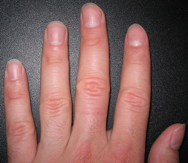 Fingernails - What Are They? - Skin Problems Center ...