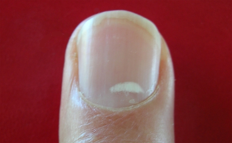 White spots on the fingernail [Leukonychia Punctata