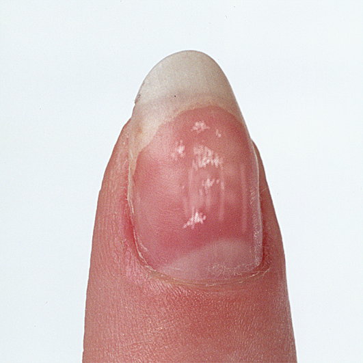 The Truth about White Spots on the Fingernail: Trauma, Stress or Zinc  deficiency! | Palm Reading Perspectives